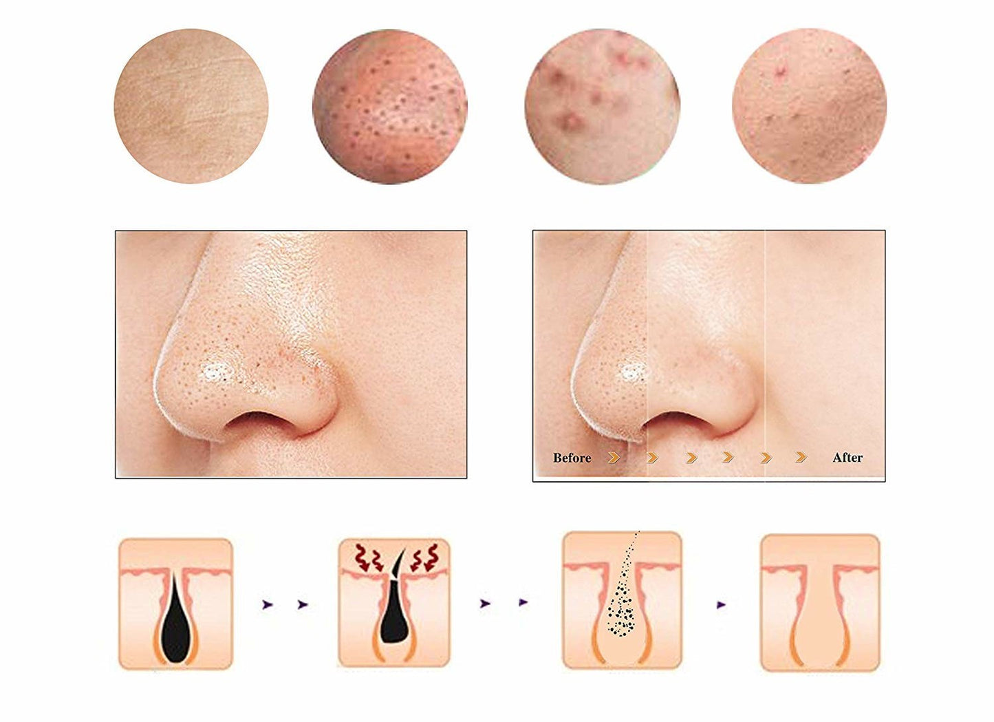 Sisone Blackhead Removal